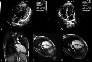 Two-dimensional transthoracic echocardiography in modified 4-chamber view showing echodense myocardial projections with sawtooth morphology (A and B); cardiac magnetic resonance imaging in 2-chamber long-axis view showing projections of apparently compacted myocardium originating from the left ventricular inferior wall (C); cardiac magnetic resonance imaging in axial 4-chamber view showing projections of apparently compacted myocardium originating from the left ventricular inferior wall and the left side of the interventricular septum (D and E).