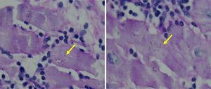Trypanosoma cruzi intracytoplasmic amastigotes (arrows). Heart muscle, hematoxylin-eosin stain, 1000×.