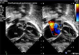 Subcostal transthoracic echocardiographic views showing the confluence of the pulmonary veins opening into the right atrium and an atrial septal defect with right-to-left shunt. ASD: atrial septal defect; LA: left atrium; LV: left ventricle; RA: right atrium; RV: right ventricle.