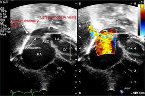 Subcostal transthoracic echocardiographic views showing drainage of the right and left pulmonary veins into the confluent chamber with a broad-mouthed opening into the right atrium. ASD: atrial septal defect; LA: left atrium; LV: left ventricle; RA: right atrium; RV: right ventricle.