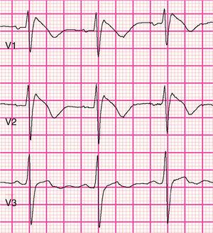Type 1 (coved-type) Brugada syndrome electrocardiogram present in V1 and V2 (courtesy of Prof. P.G. Postema and ECGpedia.org).