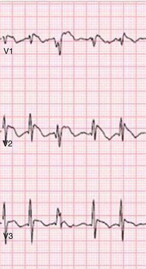 Type 1 Brugada phenocopy electrocardiogram in V1-V3, in the context of hypophosphatemia. Retrieved from Meloche et al.80.