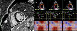 (A) Phase-sensitive inversion recovery sequence (left ventricular short axis at the level of the papillary muscles) showing overt non-ischemic delayed enhancement matching abnormal circumferential strain findings at the same level (B), especially noticed when detailed epicardium (EPI) layer analysis is performed, as provided by speckle tracking echocardiography. ENDO: endocardial; GS: global (circumferential) strain; MID: mid-myocardial.