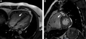 Cardiac magnetic resonance steady-state free precession cine imaging in 4-chamber view (A) and short-axis view (B) showing a severely dilated thin-walled right ventricle (arrow).