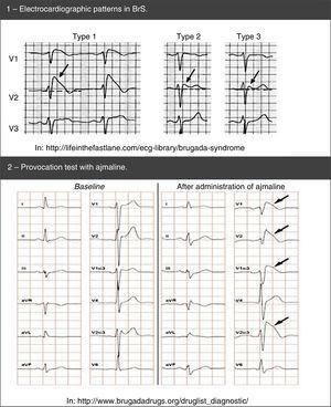 Electrocardiographic patterns in <span class=