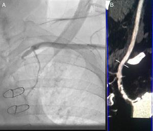 (A) Sub-occlusive stenosis of left subclavian artery on angiogram. (B) CT angiography of supra-aortic vessels shows sub-occlusive and calcified stenosis of the subclavian artery ostium with heavy calcification of the aorta.