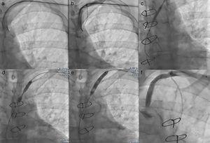 (a) First we crossed the lesion in a false lumen with a stiff guidewire with retrograde dissection of the aorta, so we withdrew the guidewire; (b) Attempt to cross the lesion with a coronary guidewire (Miracle 6); (c) Predilation of the lesion after the positioning of a TIF Tip™ 0.018 Terumo Hydrophilic Guidewire in subintima; (d) Release of the stent at the stenosis of the subclavian artery with 1 cm into the aorta; (e) Postdilation of the stent; (f) Final result with no residual stenosis and TIMI III flow of left internal mammary artery.