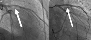 Panel A: Thrombus of the left anterior descending artery; Panel B: Total regression of the thrombus without visible stenosis.