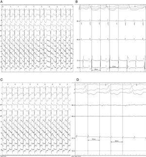 12-lead electrocardiogram (A) and intracavitary electrogram (B) of the clinical tachycardia. The tachycardia cycle length is 310 ms with a concentric activation sequence in the coronary sinus (CS 3-4 → CS 1-2). 12-lead electrocardiogram (C) and intracavitary electrogram (D) in counterclockwise atrial flutter. The baseline tachycardia cycle length is 380 ms. ABL: ablation catheter; CS: quadripolar catheter in the coronary sinus.