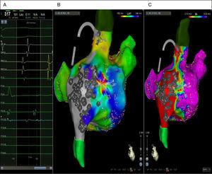 Intracavitary electrograms in the coronary sinus catheters (CS 1-2 and CS 3-4), mapping catheters (P 1-2 to P 19-20) and SmartTouch ablation catheters (MAP 1-2 and MAP 3-4) (A). PentaRay mapping catheter revealed ≥75% of the tachycardia cycle (from bipole P 1-2 to bipole P 11-12), compatible with a micro-reentry circuit. RA anatomy was mapped using the pentapolar PentaRay catheter (Biosense Webster, J&J), which enables faster anatomy mapping due to its 20 electrodes. A SmartTouch ablation catheter (Biosense Webster, J&J) with contact sensor was selected to ensure good contact with the dilated right atrium. Both the activation (B) and voltage (C) maps of the clinical atrial tachycardia were acquired using Confidence software, which automatically records points. The locations with voltage ≤0.1 mV were defined as scar (colored red) in the voltage map (C).