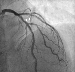 Coronary angiography with a 30% lesion in the middle segment of the LAD (white arrow). A circumflex artery (Cx) with 50% ostial stenosis, 70-90% lesion at the bifurcation to the outlet of the first obtuse marginal branch (OM1), as well as a 70-90% lesion in the ramus intermedius were found.