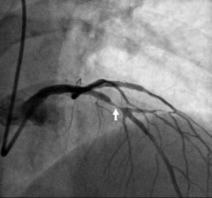 Coronary angiography showing sub-occlusive stenosis of the LAD (arrow).