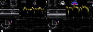 (A) Transthoracic echocardiographic images of a soldier following the special forces course, showing no left ventricular (LV) wall thickening and LV end-diastolic diameter near the upper normal limit, above-normal diastolic function parameters and normal global longitudinal strain (<span class=