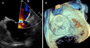 Follow-up TEE. Color Doppler 2D TEE (A) and 3D TEE (B) showing complete obliteration of LAA with no residual leak.