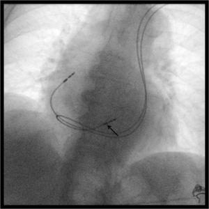 Fluoroscopic image (right oblique projection) immediately after dual-chamber pacemaker implantation through the persistent left superior vena cava, with positioning of the ventricular lead in the right ventricular outflow tract (black arrow).