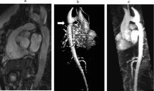 Coarctation of the aorta (white arrow) in a 24-year-old TS woman in different projections: (a) sagittal-oblique cine magnetic resonance image, (b) volume-rendered magnetic resonance aortography (posterior-oblique view), (c) magnetic resonance aortography maximum intensity projection (sagittal-oblique view).