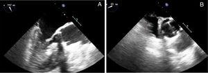 Transesophageal echocardiography which shows (A) thickening of the mitral valve, and (B) normal function of the aortic prosthesis.
