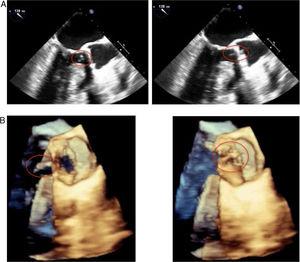 (A) 2-dimensional and (B) 3-dimensional transesophageal echocardiography. A 5-6 mm vegetation can be seen on the posterior surface of the aortic prosthesis, with a nodule persisting on the anterior surface of the mitral valve. No abscesses or other complications of infective endocarditis are observed and the mechanical aortic prosthesis discs are opening normally.