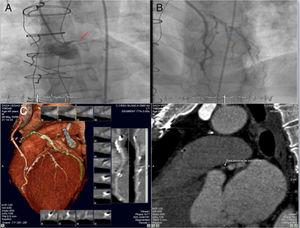 (A and B) Coronary angiogram showing chronic total occlusion of the left main coronary artery and critical left anterior descending lesion proximal to left internal mammary artery anastomosis; (C) coronary computed tomography angiography showing a short (9 mm), hardly calcified chronic total occlusion lesion: in the middle of the occlusion 100% of the coronary lumen (186 Hounsfield units) was calcified and, in the distal part, 75% of the wall circumference (933 Hounsfield units) was calcified.