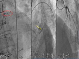Successful anterograde percutaneous coronary intervention due to chronic total occlusion of the left main coronary artery with drug-eluting stent.
