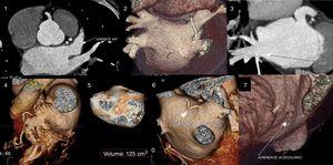 Assessment of the left atrium (LA) and left atrial appendage (LAA) by cardiac computed tomography. (1) Assessment of LAA patency; (2) assessment of LA morphology and pulmonary vein drainage; (3) detail of drainage of right inferior pulmonary vein; (4) detail of LAA morphology; (5) volumetric assessment of LA; (6) presence of a supernumerary pulmonary vein draining directly into the LA; (7) presence of a small accessory appendage. APENDICE ACESSORIO: accessory appendage; APENDICE AE: left atrial appendage; inf drt: right inferior pulmonary vein.