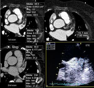 Assessment of left atrial appendage: example of the need for a second scan to differentiate between true thrombus and pseudothrombus, with corresponding transesophageal echocardiographic image (not to scale). ETE: transesophageal echocardiography.