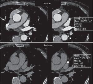 Assessment of left atrial appendage: example of the need for a second scan to differentiate between true thrombus and pseudothrombus. The latter is identified by the gain in contrast in the delayed second scan, its mean density, and the similarity of its density to that of the rest of the atrium.