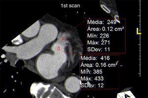 Assessment of left atrial appendage: differentiation between true thrombus and pseudothrombus. Example of a pseudothrombus with a high mean density that does not require a second scan.