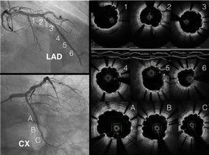 Optical coherence tomography images of the left anterior descending (LAD) and circumflex (CX) arteries, showing adequate apposition with partial covering of the struts. PCI: percutaneous coronary intervention.
