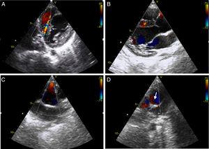 Transthoracic echocardiogram with color Doppler. Short-axis and long-axis parasternal views show interventricular systolic and diastolic flows due to the extensive collateral network (A and B); short-axis parasternal view reveals anterograde flow in the right coronary artery, which is dilated in its proximal portion (C), and retrograde flow in the main pulmonary artery (arrow), corresponding to runoff from the left coronary artery (D).
