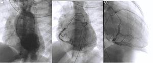 Diagnostic cardiac catheterization. Left ventriculography in posteroanterior view shows an aneurysmal region of the left ventricular apex and filling of the aorta and the right coronary artery (A); right coronary angiography in posteroanterior and right anterior oblique views shows a dilated coronary artery communicating with and filling the left coronary artery via an extensive collateral network (B and C). The left main coronary artery originates from the main pulmonary artery, and the blood flow is from aorta to right coronary artery, to collaterals, to left coronary artery, to pulmonary artery. The distal portion of the anterior descending artery is poorly filled.