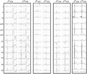 electrocardiogram
