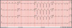 Initial 12-lead electrocardiogram showing sinus tachycardia at 140 bpm, QS pattern in leads V1-V4, and first-degree atrioventricular block following one premature ventricular contraction.