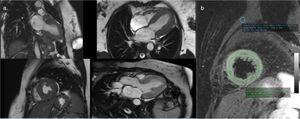 Cardiac magnetic resonance imaging cine sequences (a) showing mild hypokinesia of the mid segments of both anterior and anteroseptal walls and preserved global left ventricular systolic function; (b) T2-weighted short tau inversion recovery sequence revealing diffuse myocardial edema.