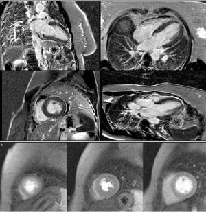 Cardiac magnetic resonance imaging, contrast-enhanced sequences with gadolinium (a) and perfusion sequences (b), showing no significant late enhancement and no perfusion defects.