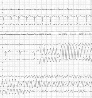 24-hour Holter monitoring demonstrating monomorphic ventricular tachycardia triggered by a ventricular extrasystole.