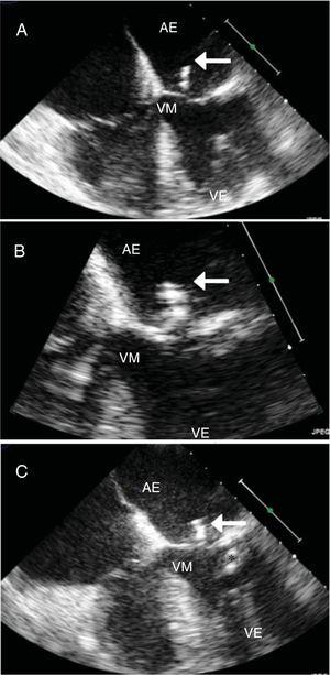 Transesophageal echocardiography (TEE) showing nonbacterial thrombotic endocarditis. (A and B) Initial TEE showing a vegetation on the mitral valve posterior leaflet (arrow); (C) following a course of antibiotic therapy, the vegetation can still be observed on the mitral valve posterior leaflet (arrow) and a new vegetation around 10 mm in size has appeared attached to the chordae tendineae of the posterior leaflet (asterisk). AD: right atrium; AE: left atrium; VD: right ventricle; VE: left ventricle; VM: mitral valve.