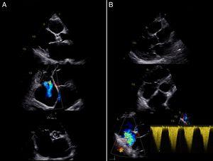 Transthoracic echocardiography showing native heart (A) with severely dilated chambers and Amplatzer device at the site of the aortic valve, and donor heart (B) with mild dilatation of the right ventricle and severe tricuspid regurgitation.