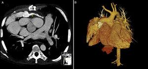 (A) Computed tomography angiography showing a non-occlusive thrombus in the conduit (asterisk); (B) three-dimensional reconstruction of the patient's complex cardiac anatomy.