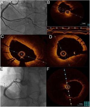 (A) Angiographic follow-up after one week; (B–D) optical coherence tomography (OCT) imaging showing dissection of the posterolateral branch with a high thrombotic load; (E) angiographic follow-up six months after the acute event; (F) OCT follow-up six months after the acute event.