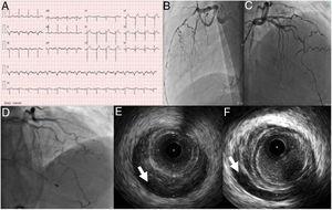 (A) Electrocardiogram on admission; (B and C) coronary angiography showing spontaneous dissection of the left anterior descending (LAD) artery occupying all of the mid and distal segments and extending to the posterolateral branch; (D) coronary angiography performed after cardiac arrest 30 hours after admission, revealing apparent progression of the LAD dissection; (E and F) intravascular ultrasound images of an intramural hematoma extending from the proximal LAD (arrow).