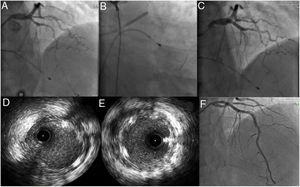 (A) Passage of the floppy guidewire to the distal left anterior descending artery; (B and C) implantation of a 3.50mm×23mm AbsorbTM bioresorbable vascular scaffold; (D and E) intravascular ultrasound images after implantation of the Absorb scaffold showing good apposition and expansion, sealing the proximal entry to the dissection; (F) implantation on day 6 of two AbsorbTM scaffolds (3mm×28mm and 2.5mm×23mm) and a XIENCE AlpineTM drug-eluting stent (2.5mm×38mm), with a good final angiographic result.