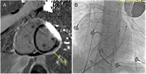 (A) Cardiac magnetic resonance with late gadolinium enhancement of the epicardial surface of the left ventricular lateral wall (arrow: fibrotic tissue); * denotes a visual artifact caused by the cardioverter-defibrillator lead; (B) chest X-ray during the ablation procedure; * indicates the closed Orion catheter in the pericardial space.
