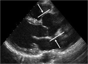 Echocardiographic image, long-axis parasternal view, in a patient with Marfan syndrome, showing dilatation of the aortic root (lines) and sinuses of Valsalva (arrows).