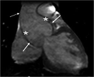 Still image from cine magnetic resonance imaging in a patient with Marfan syndrome, showing dilatation of the aortic root (solid arrows), effacement of the sinotubular junction (asterisks), and dilatation of the proximal ascending aorta (dotted arrow).