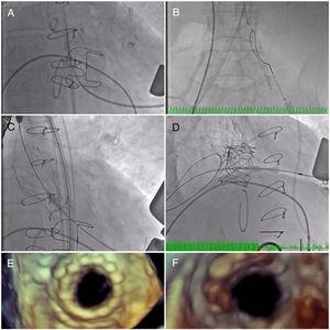 (A) A long Emerald J wire passes through the stenotic Mitroflow, in which it is captured with an Amplatz Goose Neck snare (B); valve-in-valve implantation of a 23-mm CoreValve Evolut R in aortic position by the transfemoral route (C); implantation of a 29-mm Edwards SAPIEN 3 in mitral position by the transapical route (D); new aortic (E) and mitral (F) bioprosthetic valves visualized by transesophageal echocardiography during the procedure following implantation.