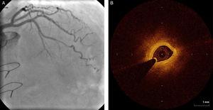 (A) Coronary angiography showing intermediate stenosis in the mid segment of the left anterior descending artery; (B) optical coherence tomography showing intimal thickening (minimum luminal area 0.98 mm2).