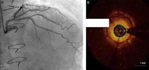 (A) Coronary angiography showing severe in-stent restenosis in the mid segment of the left anterior descending artery; (B) optical coherence tomography showing focal in-stent restenosis (minimum luminal area 1.26 mm2).