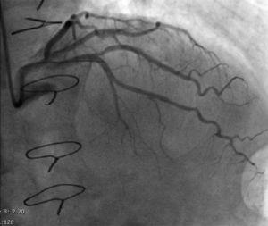 Coronary angiography showing the left anterior descending artery after paclitaxel-coated balloon angioplasty.