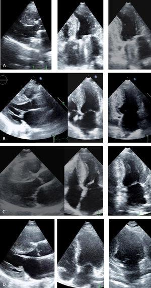 Transthoracic echocardiogram, parasternal long-axis, 4-chamber and 2-chamber views: (A, Case 1): asymmetric hypertrophic cardiomyopathy (HCM) (maximum wall thickness [MWT] 16 mm) and normal prosthetic mitral function; (B, Case 2): asymmetric HCM (MWT 22 mm); (C, Case 3): asymmetric HCM (MWT 21 mm); (D, Case 4): asymmetric HCM (MWT 22 mm).